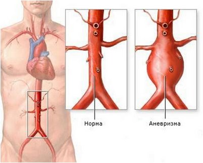 аневризм