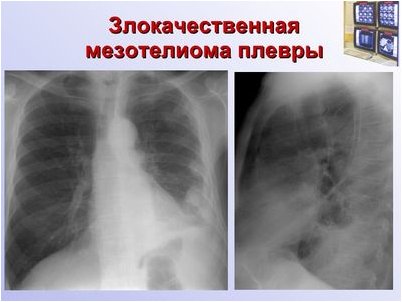 мезотелиома мезотелиома