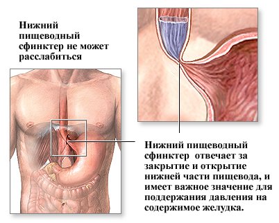 изжога изжога