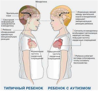аутизм аутизм