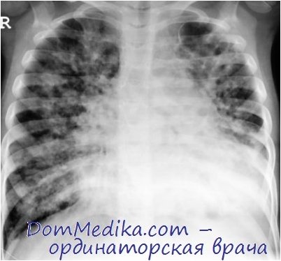 муковисцидоз муковисцидоз
