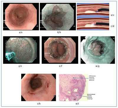 Радиочастотная абляция и полная эндоскопическая резекция одинаково эффективны при диспластическом пищеводе Барретта