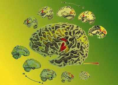 Усилитель мозга при биполярном расстройстве