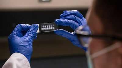 Клетки мозга у пациентов с болезнью Альцгеймера потребляют ресурсы, необходимые для нейротрансмиссии