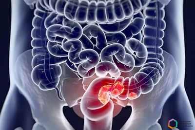 Потребление кальция и колоректальный рак