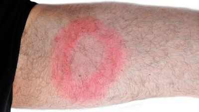 `` Вода на коленях '' может быть ранним признаком болезни Лайма