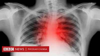 7 из 10 основных смертей до COVID были неинфекционными заболеваниями: ВОЗ