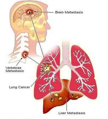Метастазы рака легких могут перемещаться по дыхательным путям в прилегающие или отдаленные ткани легких