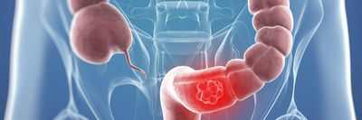 Положительный результат нового анализа крови на ДНК на рак кишечника