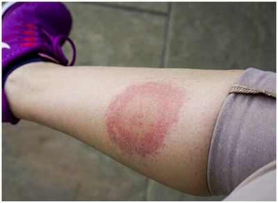 Все, что вам нужно знать о болезни Лайма