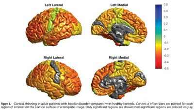Нейровизуализация может предложить новый способ диагностики биполярного расстройства