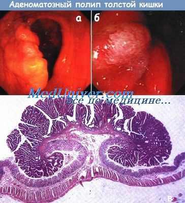 Темнокожие пациенты с повышенным риском полипов толстой кишки
