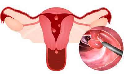 Исследование сравнивает частоту обнаружения полипов при колоноскопии и характеристики эндоскописта