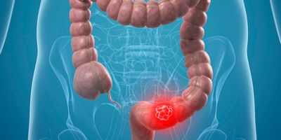 Синдром наследственного рака толстой кишки, характеризующийся аномально плотным ростом кровеносных сосудов во рту
