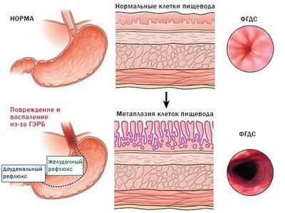 DFMO может повлиять на пищевод Барретта