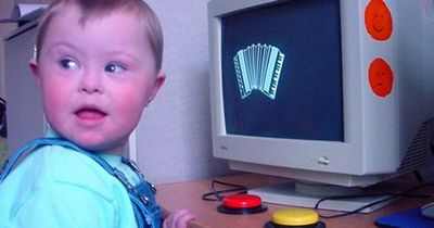 Лечение нового синдрома Дауна, предложенное исследованием на мышах