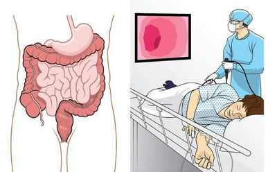 Исследование: Колоноскопия после 75 может не стоить того