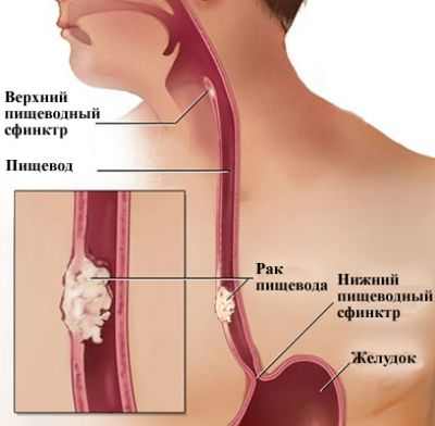 Обнаружена генетическая связь с пищеводом Барретта и раком пищевода Обнаружена генетическая связь с пищеводом Барретта и раком пищевода
