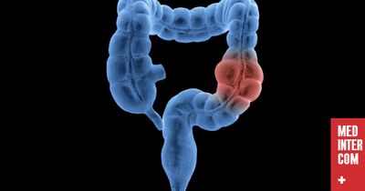 Новые исследования показывают, что скрининг на рак прямой кишки должен начинаться в 45 лет Новые исследования показывают, что скрининг на рак прямой кишки должен начинаться в 45 лет